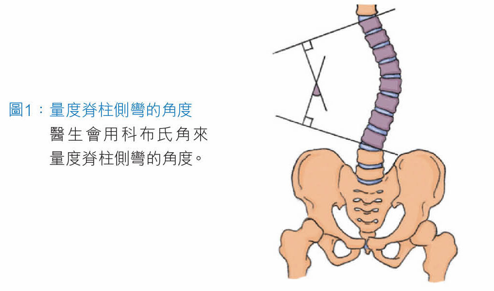 量度脊柱側彎的角度醫生會用科布氏角來量度脊柱側彎的角度。